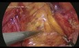 Laparoskopowa operacja przepukliny pachwinowej