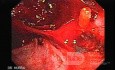 Ostre krwawnienie po wykonaniu biopsji (7 z 7)