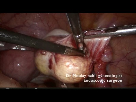 Laparoskopowa cystektomia torbieli dermoidalnej jajnika