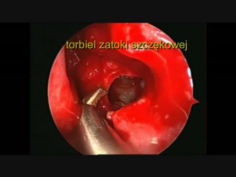Endoskopowa operacja zatok szczękowych
