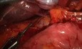 Laparoskopowa kontrola krwawienia w trakcie anatomicznej resekcji wątroby