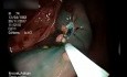 Piecemeal Ascending Colon LST-G Resection