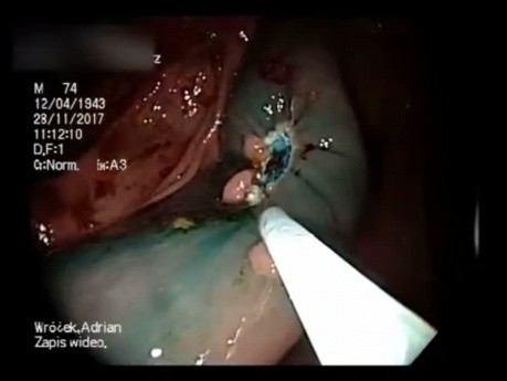 Endoskopowa resekcja zmiany o typie LST-G wstępnicy techniką mukozektomii