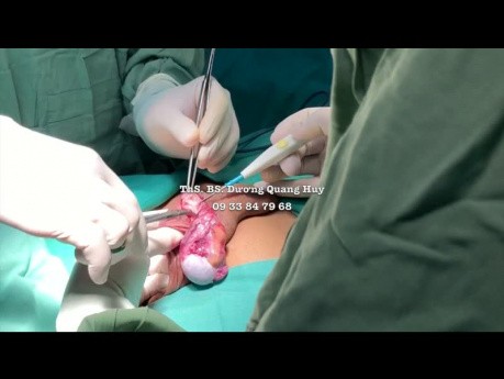 Operacja mikrochirurgiczna żylaków powrózka nasiennego