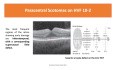 Retinopatia po hydroksychlorochinie (Plaquenil) - pełny przewodnik od A do Z
