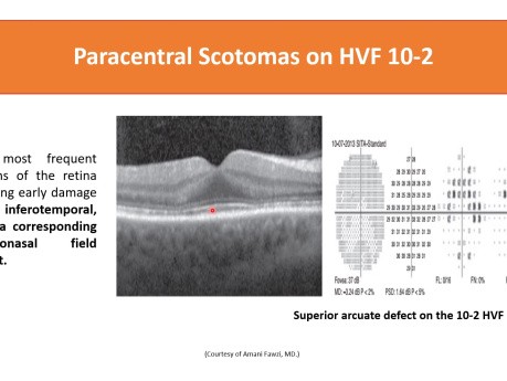 Retinopatia po hydroksychlorochinie (Plaquenil) - pełny przewodnik od A do Z