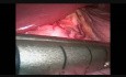 Laparoskopowa rękawowa resekcja żołądka 
