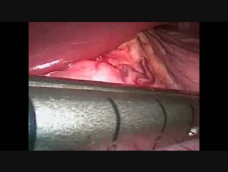Laparoskopowa rękawowa resekcja żołądka 