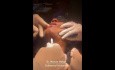 Intubacja podbródkowa (submental intubation) u pacjenta ze złożonym urazem twarzoczaszki