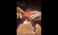 Intubacja podbródkowa (submental intubation) u pacjenta ze złożonym urazem twarzoczaszki