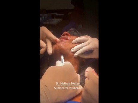 Intubacja podbródkowa (submental intubation) u pacjenta ze złożonym urazem twarzoczaszki