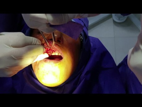 Wydłużenie korony klinicznej zęba