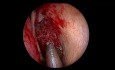 Całkowita endoskopowa operacja zatok - systematyczne podejście od przodu do tyłu