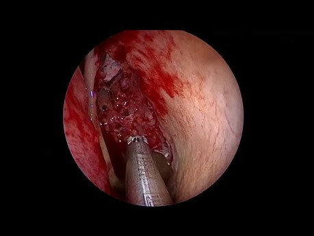Całkowita endoskopowa operacja zatok - systematyczne podejście od przodu do tyłu