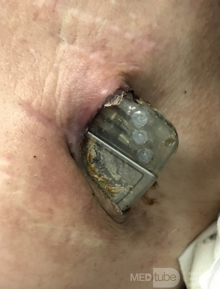 Odleżyna loży wszczepianego kardiowertera defibrylatora z perforacją