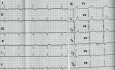 Kardiomiopatia przerostowa - EKG, echokardiografia i leczenie