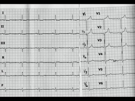 Kardiomiopatia przerostowa - EKG, echokardiografia i leczenie