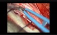 Mikrochirurgiczne usunięcie wewnątrzoponowego guza o typie nerwiakowłókniaka