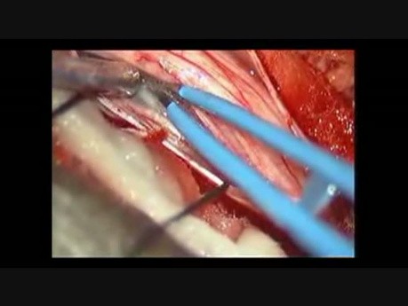 Mikrochirurgiczne usunięcie wewnątrzoponowego guza o typie nerwiakowłókniaka