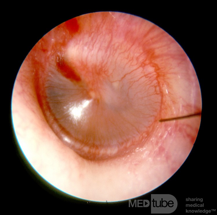 Wczesne ostre zapalenie ucha środkowego: stadium zaczerwienienia