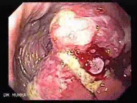 Nawrotowy gruczolakorak żołądka - endoskopia (2 z 4)
