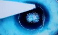 Laserowa korekcja wzroku - LASIK - reoperacja krótkowzroczności 