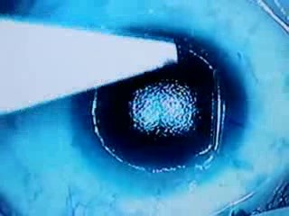 Laserowa korekcja wzroku - LASIK - reoperacja krótkowzroczności 