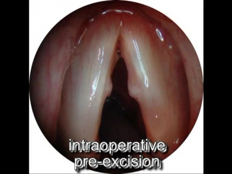Endoskopowa mikrochirurgia guzków śpiewaczych