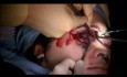 Wielomiejscowe złamanie kości twarzy - leczenie
