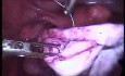 Laparoskopowa operacja dużej torbieli endometrialnej jajnika