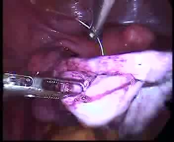 Laparoskopowa operacja dużej torbieli endometrialnej jajnika