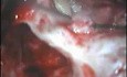 Perlak- mastoidektomia z tympanoplastyką typu zamkniętego (CWU – canal wall up)- cz. 3