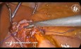 Konwersja pionowej rękawowej resekcji żołądka do mini bypassu żołądka