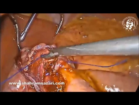 Konwersja pionowej rękawowej resekcji żołądka do mini bypassu żołądka