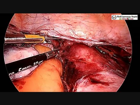 Całkowita laparoskopowa histerektomia przy dużym rozmiarze macicy i mnogich mięśniakach
