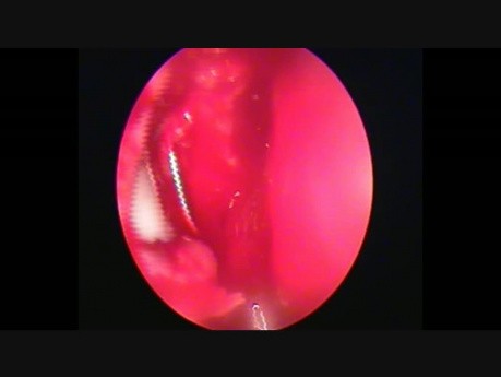 Obustronna dacryocystorhinostomia endoskopowa