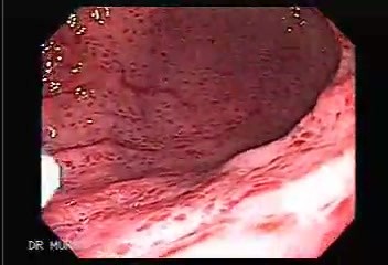 Ostre zapalenie żołądka - Endoskopia