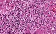 Ostra białaczka szpikowa - histopatologia - wątroba