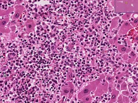 Ostra białaczka szpikowa - histopatologia - wątroba