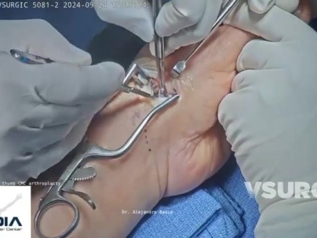 Hemiartroplastyka stawu nadgarstkowo-śródręcznego (CMC) kciuka z użyciem modularnego implantu kciuka
