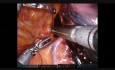 Robotowa resekcja płuca prawego 