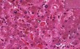Hemochromatoza - histopatologia - wątroba