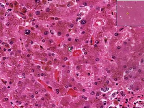 Hemochromatoza - histopatologia - wątroba