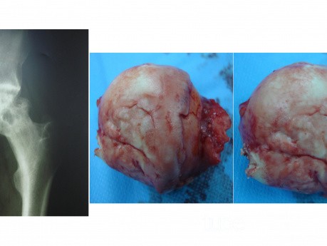 Jałowa martwica głowy kości udowej
