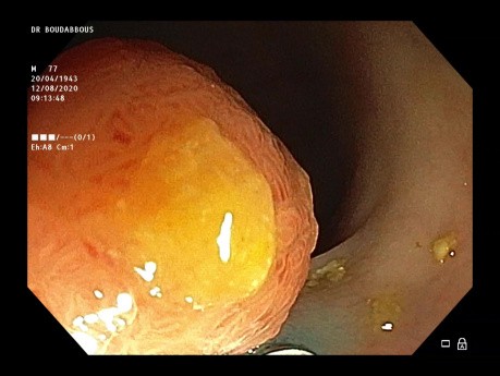 Mukozektomia endoskopowa (EMR) guza LST-G esicy w kawałkach