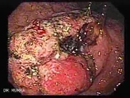 Rak gruczołowy jamy odźwiernikowej (1 z 5)