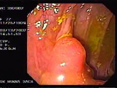 Gruczolakorak okrężnicy poprzecznej - endoskopia (1 z 9)