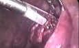 Zabieg laparoskopowy w ciąży ektopowej