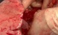 Uso de parche pericárdico para la reconstrucción de la mesa posterior de la aurícula izquierda