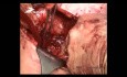 Operacja organooszczędzająca guza nerki jedynej